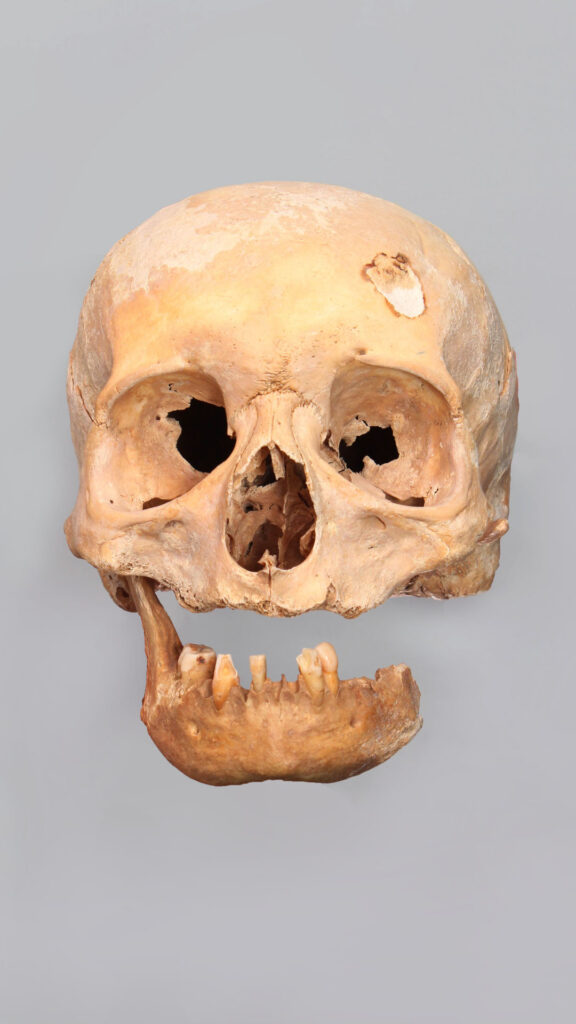 Skull damaged over time